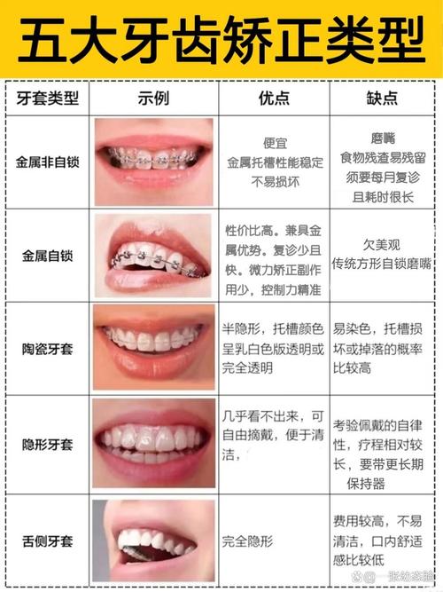 牙套之家：牙齿矫正怎么选？牙套种类、日常护理与保持器须知